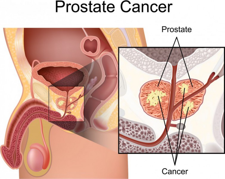 El cáncer silencioso, el cáncer de próstata