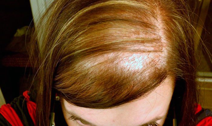 Aumentan los casos de alopecia en las mujeres
