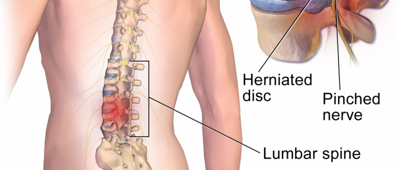 Dolor de espalda, puede ser fisura, hernia o protusión